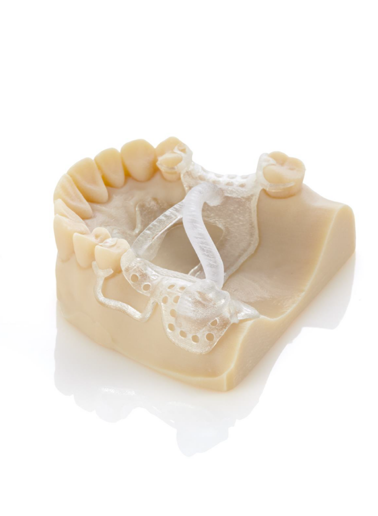 Denture cast made with KeyCast